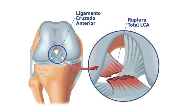 Lesão do ligamento cruzado anterior (LCA) do joelho