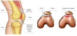 Condropatia - Condromalácia Patelar