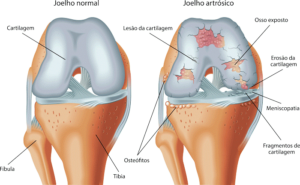 artrose do joelho
