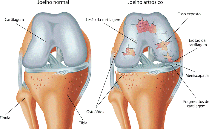 Artrose do joelho Ortoprime Ortopedia Brasília DF